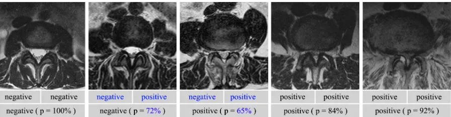 Figure 8: Example images with diﬀerent degrees of degeneration. First row: the repeatedlabels for central stenosis by the same clinician, made at diﬀerent times