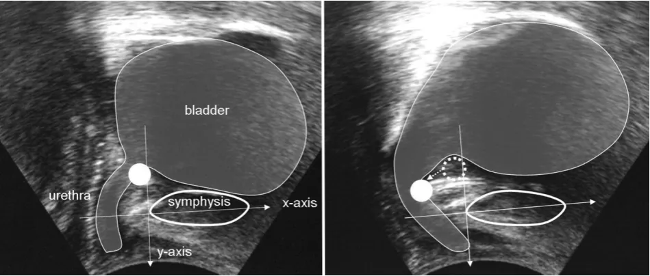 Fig. 1a, b. Perineal ultrasound for evaluating the bladder neck mobility. Bladder neck at rest (Fig