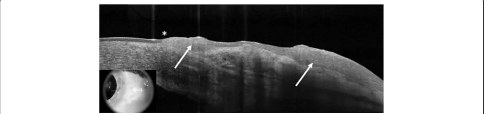Fig. 1 HR-OCT image of OSSN. High-resolution anterior segment optical coherence tomography (HR-OCT) image of a patient with ocular surfacesquamous neoplasia (OSSN)