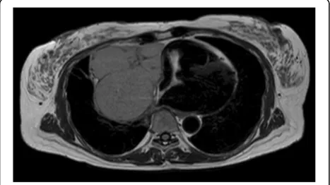 Fig. 1 Chest radiography (a) and chest computed tomography (b) at the first visit show a large mass in the right lower lung field