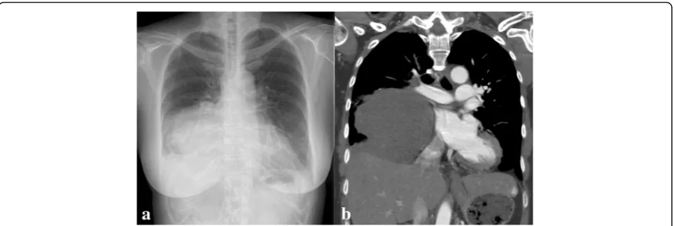 Fig. 3 Second chest radiography (a) shows an enlarged mass with an irregular shape. Enhanced computed tomography (b) after theadmission demonstrates occlusion of the right inferior pulmonary vein due to tumor compression