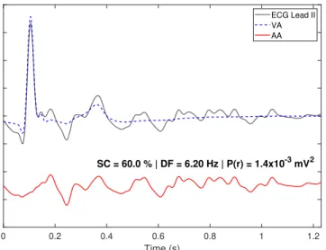Fig. 4: Original recording, VA and AA estimates in lead II by the L¨owner-based BTD of Patient P7