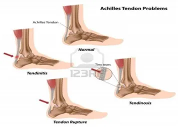 Figure 2.8. Achilles tendon disorders. Image taken from [27]. 