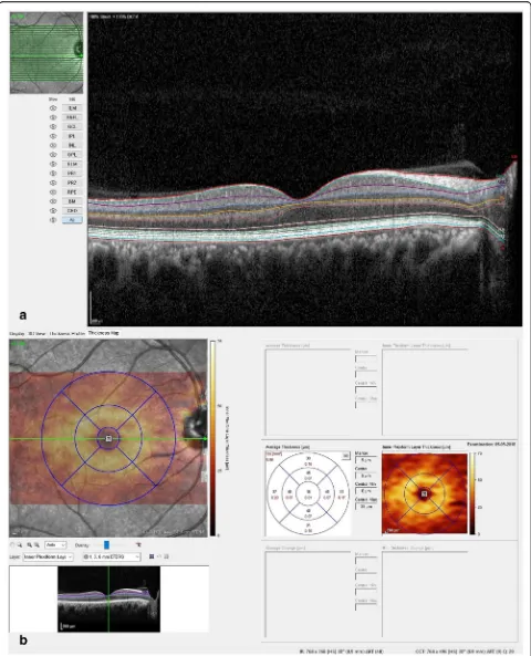 Fig. 1 Retinal layer segmentation on Heidelberg Spectralis SD-OCT machine. a Automated retinal layer segmentation using the HeidelbergSpectralis machine