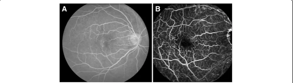 Fig. 1 Retinal function imager capillary perfusion map compared to fluorescein angiogram