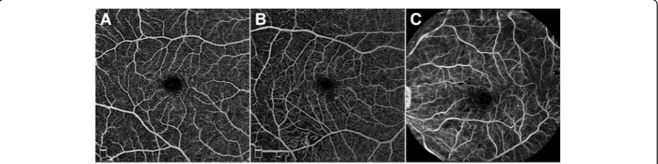 Fig. 2 Retinal function imager capillary perfusion map compared to optical coherence tomography angiography.in the inferotemporal macula