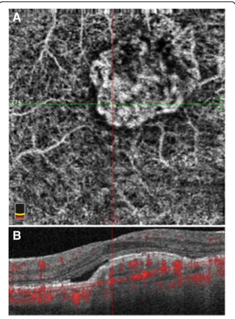 Fig. 3 Projection artifacts in optical coherence tomographyCorresponding structural OCT B-scan demonstrating the neovascularlesion co-localized to theangiography