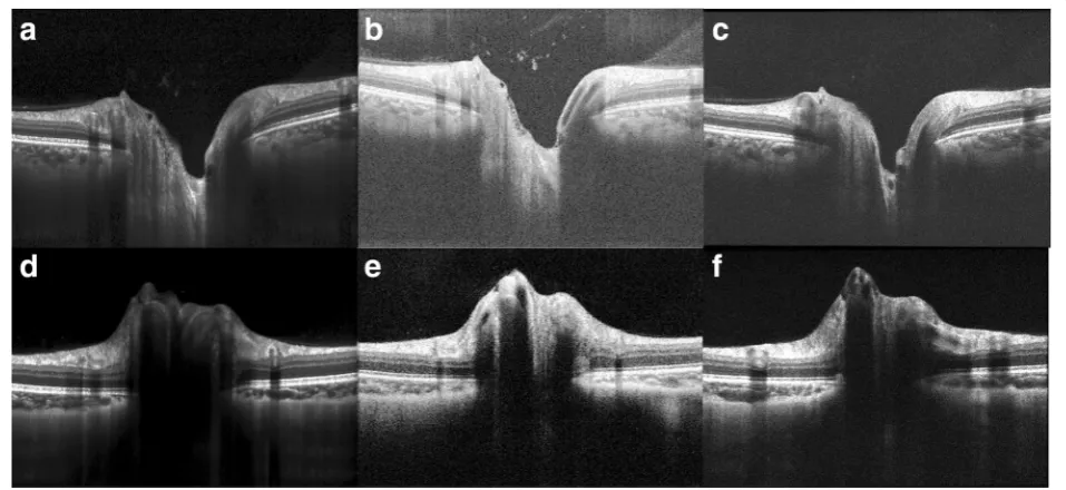 Fig. 2 Approximately 9-mm OCT line scans oriented to intersect the fovea and the center of the optic nerve