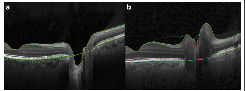 Fig. 4 Inter-rater segmentation variability (segmentation within the cup of the optic nerve due to a possible artifact
