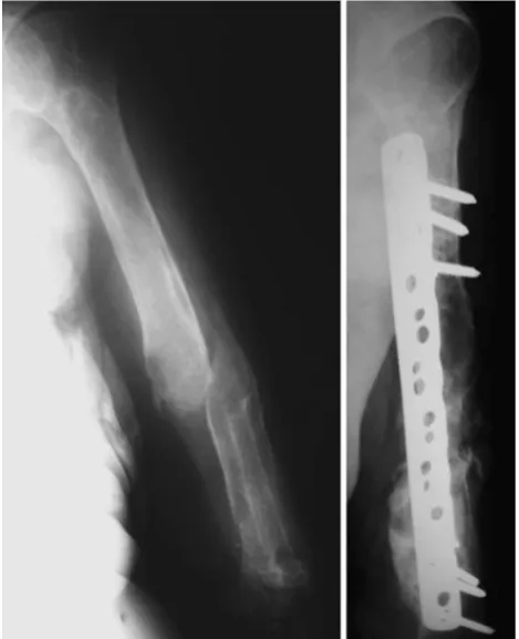 Fig. 3 Atrophic nonunion in an osteoporotic bone (left). Aftercleaning and grafting focus and bridge-plate ﬁxation with lockingplate and screws, the nonunion is healed (right)