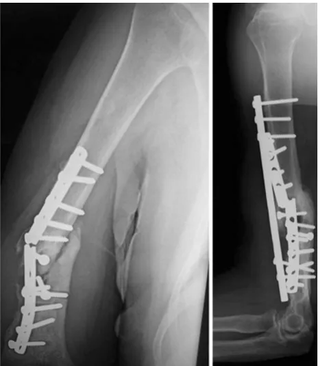 Fig. 4 X-ray images (frontal and lateral views) demonstrate atrophic nonunion instability signs—varus alignment and initial plate bending (left).Six weeks postoperatively with bone formation in the nonunion site (right)