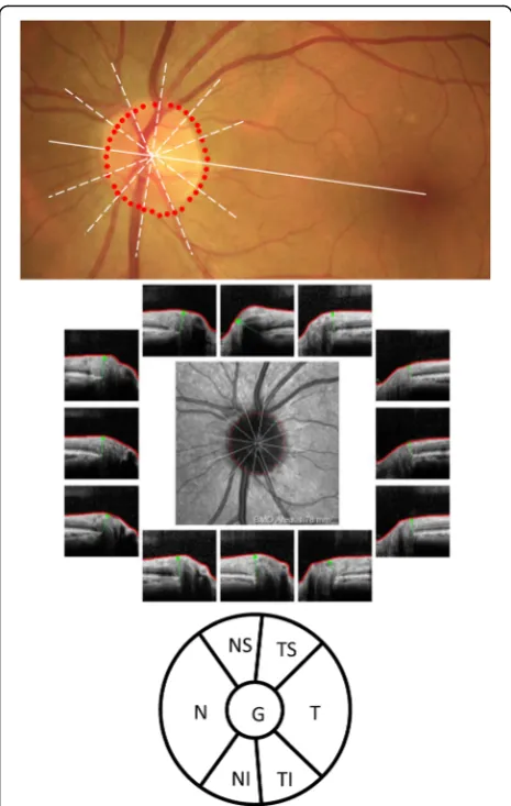 Fig. 2 Quantification of minimum rim width (MRW) with SpectralisOCT. OCT fundus photograph (top panel) with disc margin (red dots)as the device will place it