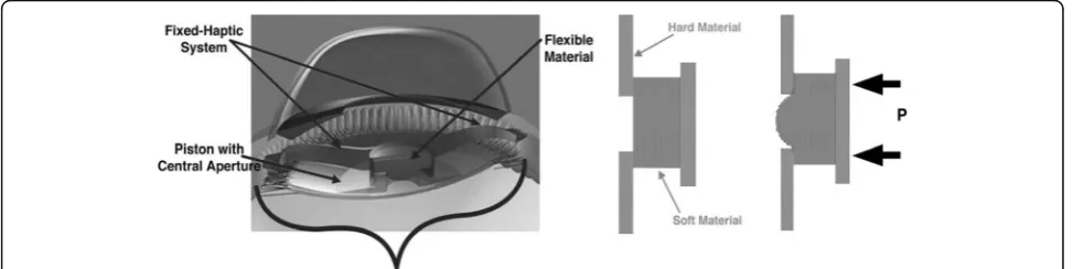 Fig. 7 Contrast sensitivity function after Lumina AIOL implantation. Reprinted with permission from [36]