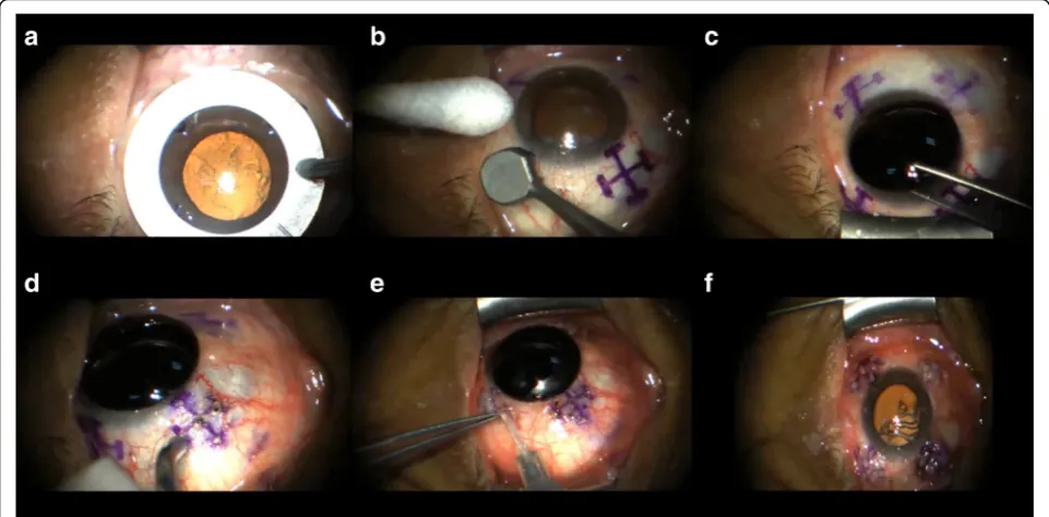 Fig. 2 LaserACE surgical technique. Photo a Quadrant marker; b Matrix marker; c Corneal Shield; d LaserACE micropore ablation; e SubconjunctivalCollagen; f Completed 4 quadrants