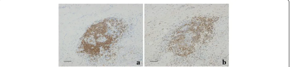 Fig. 2 The expression of CD35+ cells in lymphoid neogenesis.( a The network of CD35+ FDCs in GC-like structures (grade 3) (arrow)