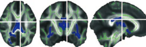 FIGURE 6Regions of the brain in which FA is lower in adolescents born preterm. The voxels depicted in blueindicate WM tracts where FA is lower in formerly preterm adolescents than in matched controlsubjects (P � .01, after correction for multiple compariso