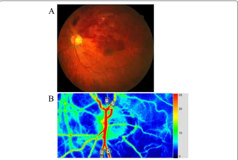 Fig. 1 Representative fundus color photograph and representative RFV data obtained with LSFG.retinal vein occlusion (BRVO)