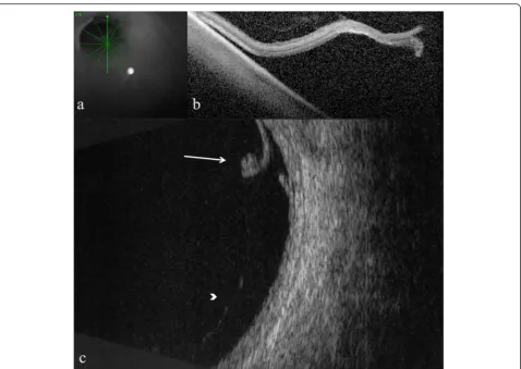 Fig. 5 Optical coherence tomography and B-scan ultrasonography showing retinal tear and vitreo-retinal traction