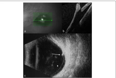 Fig. 6 Optical coherence tomography and B-scan ultrasonography showing retinal tear and vitreo-retinal traction