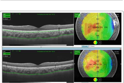 Fig. 1 Automatically plotted reference lines and the colored topographic map of the nine subfields as defined by the Early Treatment DiabetesRetinopathy Study-style grid in both eyes