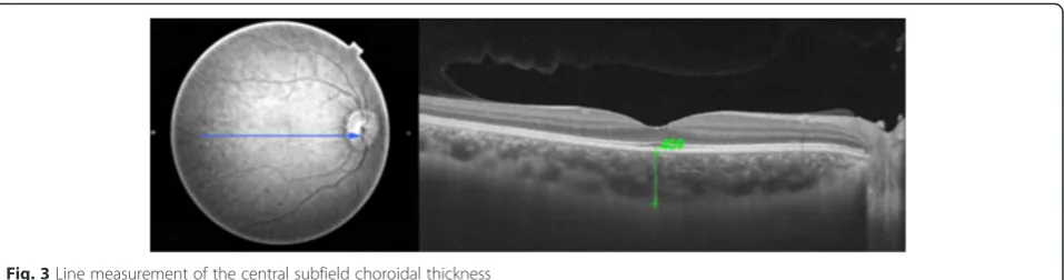 Fig. 3 Line measurement of the central subfield choroidal thickness