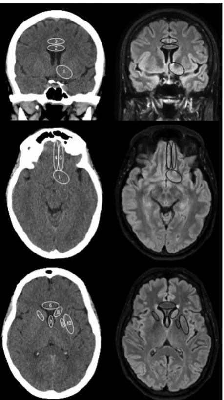 Figure 3.1 Proforma for identification of infarct location (multiplanar CT reconstructions, left and FLAIR axial and coronal images, right): (1) basal forebrain; (2) body of corpus callosum; (3) cingulate gyrus; (4) gyrus rectus; (5) medial olfactory gyrus