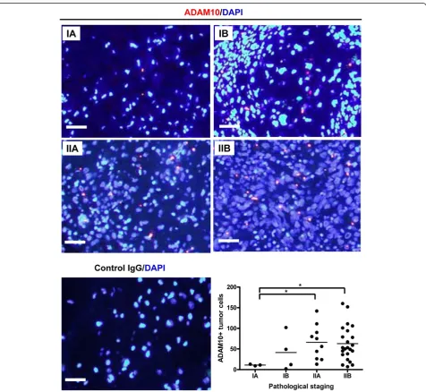 Figure 1 Increased expression of ADAM10 in higher-stage osteosarcoma tissue. The panels show representative images of the cytoplasmicADAM10 domain (red dots) merged with 4′,6-diamidino-2-phenylindole (DAPI)-stained nuclei (blue) taken from osteosarcoma tis