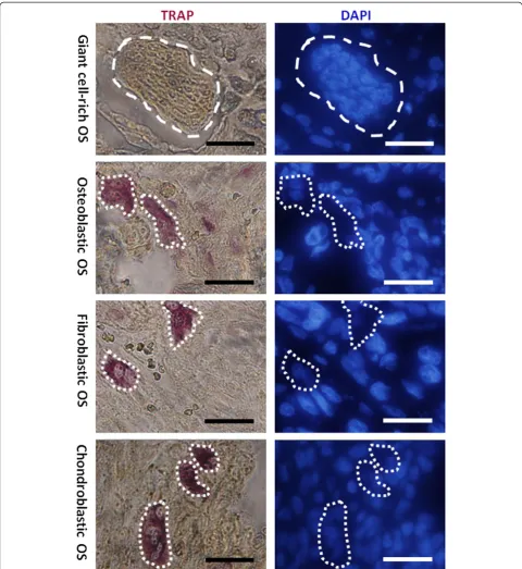 Figure 5 TRAP/DAPI staining of various histological types of osteosarcoma. The left panels show tartrate-resistant acid phosphatase (TRAP)staining of giant cell-rich, osteoblastic, fibroblastic and chondroblastic osteosarcomas, respectively