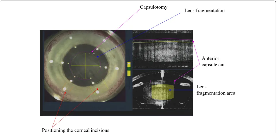 Fig. 3 The LenSx femtosecond laser