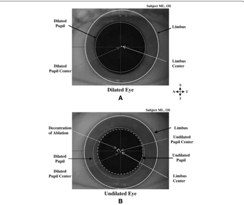 Figure 3 Images of the same left eye in pharmalogically and naturally dilated states. Here (A) represents pharmacologically dilated state(Neo-Synephrine 2.5%) and (B) represents natural undilated state
