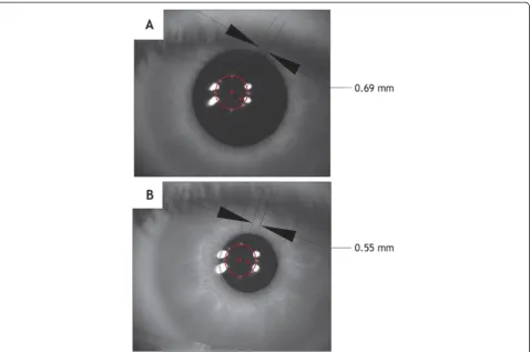 Table 2 Centration parameters of the human eye reported by various research groups