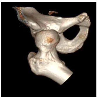 Figure 6: Coronal MRI of the hips and pelvis 