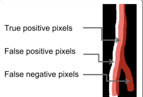 Figure 4 True positive (TP); False positive (FP); False negative(FN) pixels for precision and recall calculation