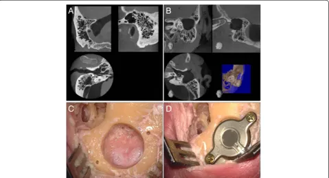 Figure 1 Preoperative CBCT (A and B) and intraoperative images (C and D).mastoidectomy Preoperative radiological visualisation by CBCT of the site in thecase of a well-pneumatised and not pre-operated mastoid (A) as well as a site with prior surgery in ter