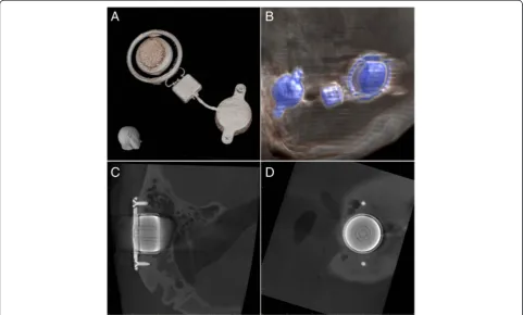 Figure 2 Visualisation of the implant.of the implant details including the inner structure and fixing screws in CBCT Three-dimensional reconstruction of the implant from the raw data of the CBCT (A) and CT (B)