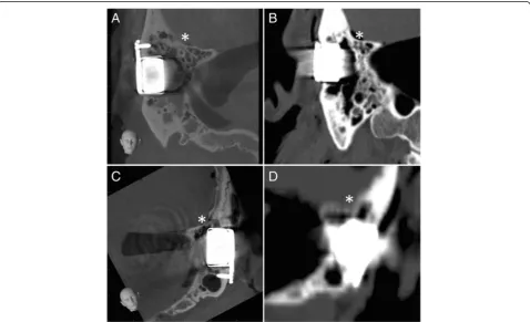 Figure 3 Positional relation of the implant to the posterior cranial fossa. Visualisation of the implants in CBCT (A and C) and in CT (B and D)for both prepared skulls (A and B, head 1; C and D, head 2) in relation to the surrounding brain structures (*).