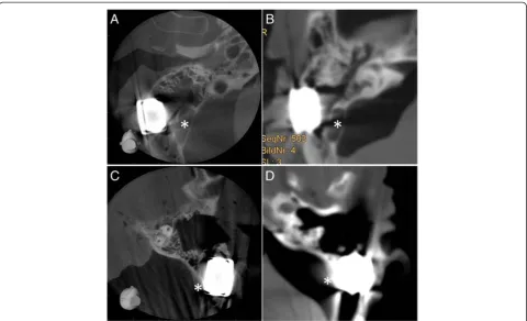 Figure 4 Positional relation of the implant to the sinus sigmoideus. Visualisation of the implants in CBCT (A and C) and in CT (B and D) forboth prepared skulls (A and B, head 1; C and D, head 2) in relation to the sinus sigmoideus (*).