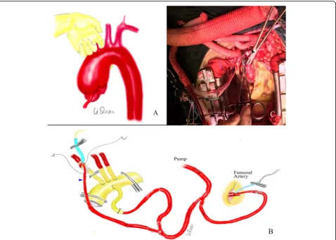 Fig. 1 a“ Method for separation of the aortic arch and tracheal space. b Method of cannulation for extracorporeal circulation and perfusion