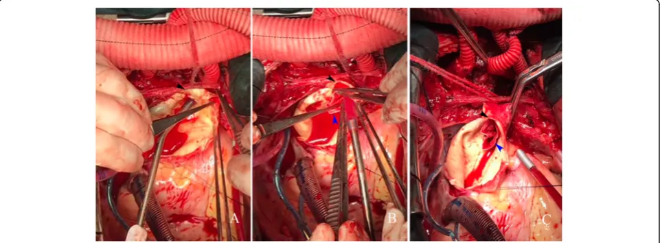 Fig. 2 a Ascending aortic incision and descending aorta probing. b The stented graft is inserted into the descending aorta