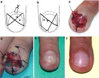 Fig. 4 a X-shaped suture,b U-shaped suture, c nail-bedsuture, d nail-substituteX-shaped suture, e clinicalresult at 4 months, f clinicalresult at 12 months