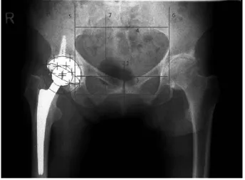 Fig. 1. Example of EbRa analy-sis of an a.p. pelvic film with de-termination of cup and head po-sition