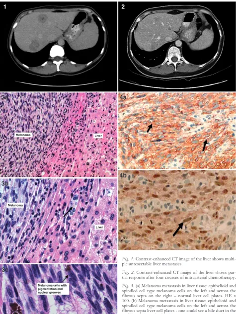 Fig. 3. (a) Melanoma metastasis in liver tissue: epithelioid andcells with nuclear grooves and pigmentation, melanophagesmiddle of the slide (black arrow)