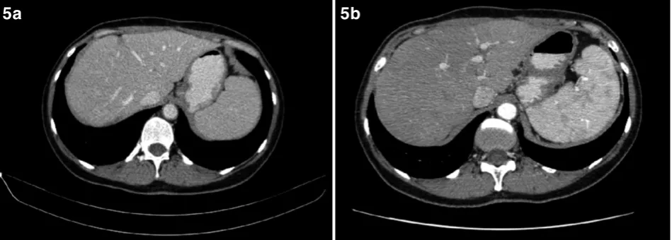 Fig. 5. (a) Contrast-enhanced CT image of the liver 9 and (b) 21 month after resection of the liver metastases shows only post-surgical lesions.