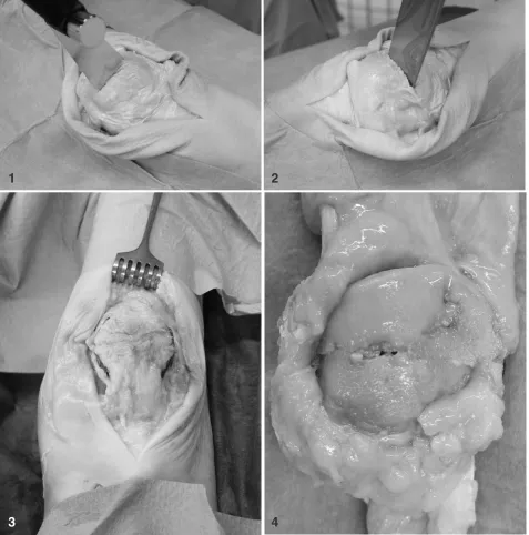 Fig. 1. transverse osteotomy in the middle of the patella using a surgical saw.Fig. 3