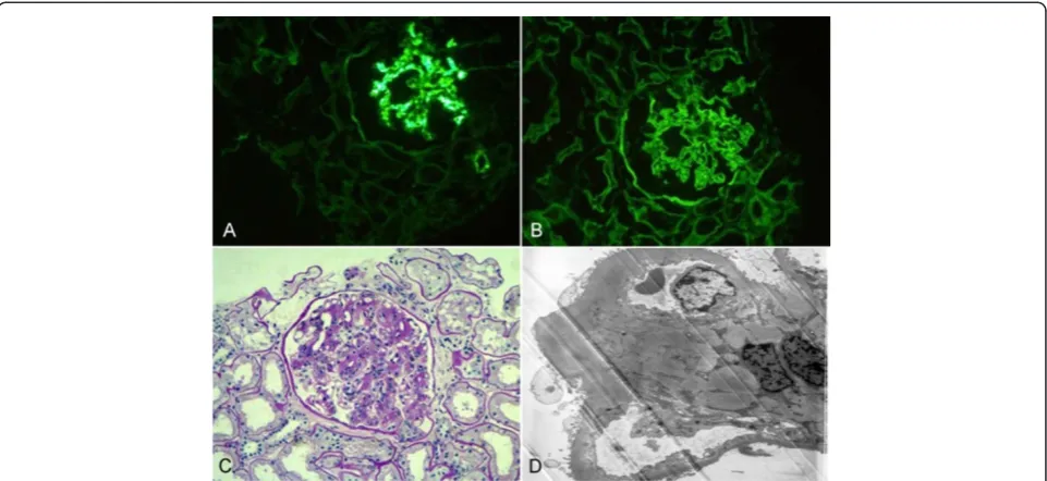 Figure 2 A case with chronic tubular interstitial nephritis (TIN) and diabetic nephropathy (DN).basement membrane and appeared in a linear pattern as viewed by immunofluorescence (IF, 200×)