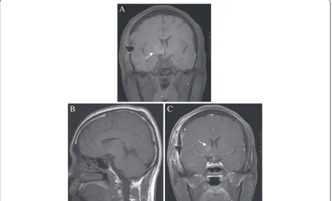 Figure 3 Magnetic resonance images of postoperative follow-up. (A,B) MRI scanning and (C) enhanced scanning revealed the completeremoval of chiasmal cavernous malformations and no recurrence, but a hyperintensity in the basal ganglia was found (arrows).