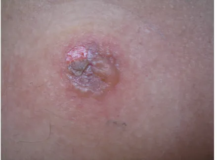FIGURE 1. Blistering and ulceration secondary to irritative contact between the skin and  the  delivery  mechanism  of  the  drug  on  the  patch