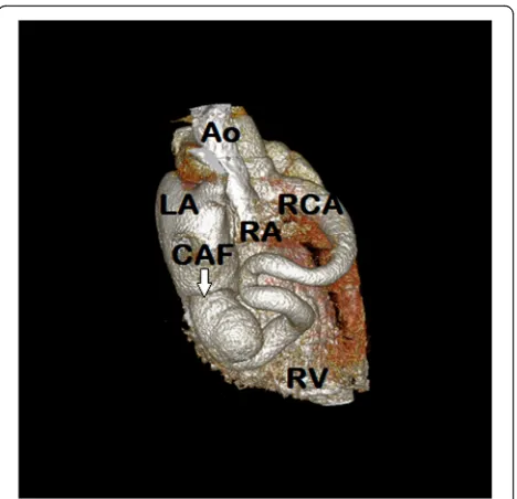 Fig. 4 Operative photograph showing fistula tract of the aneurysmalright coronary artery and surrounding structures
