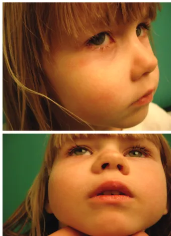 FIGURE 1Swelling overlying the right maxillary sinus.