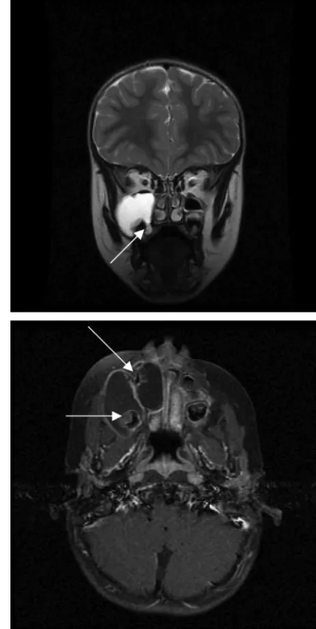 FIGURE 2Two large expansile cystic lesions are seen within the right facial region occluding theostiomeatal complex, obliterating the maxillary antrum, elevating the orbital ﬂoor, anddepressing the hard palate (white arrows)